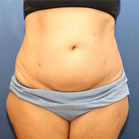 before tummy tuck front view female patient case 4990