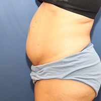 before tummy tuck left side view female patient case 4990