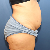 before tummy tuck right side view female patient case 4990