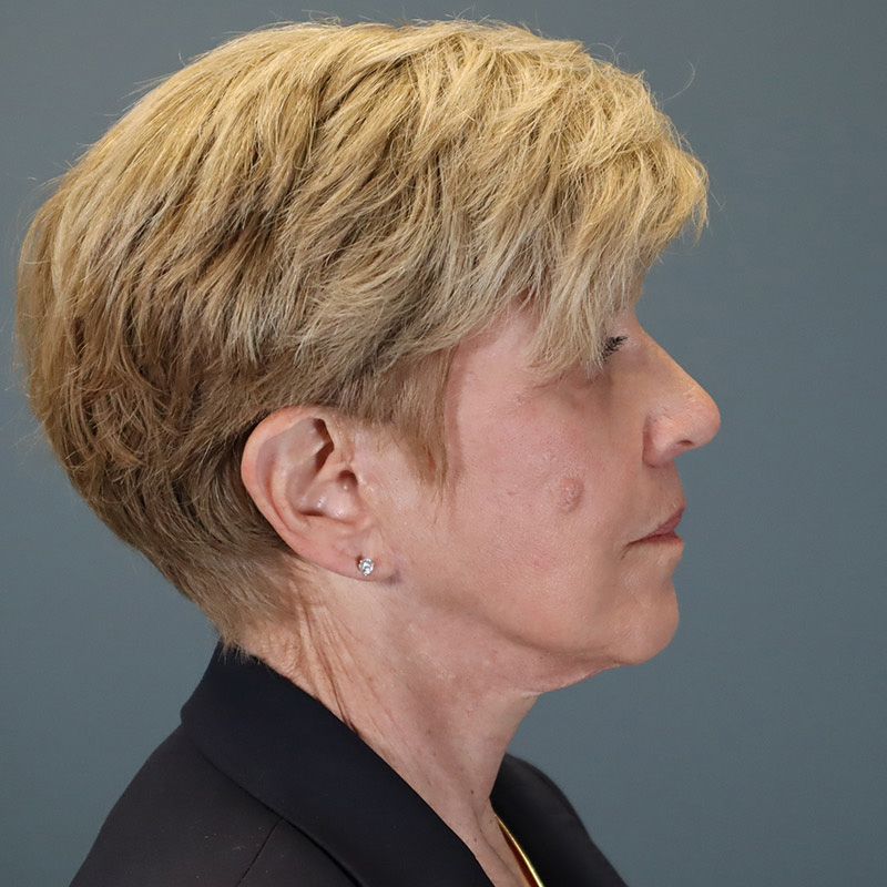 after facelift right side view female patient case 5052