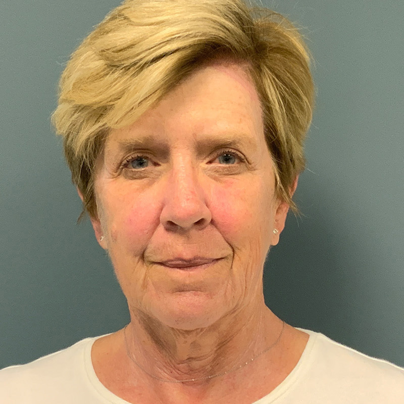 before facelift front view female patient case 5052