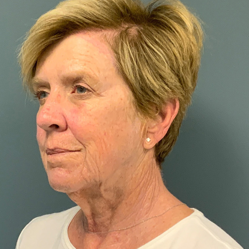 before facelift left view female patient case 5052