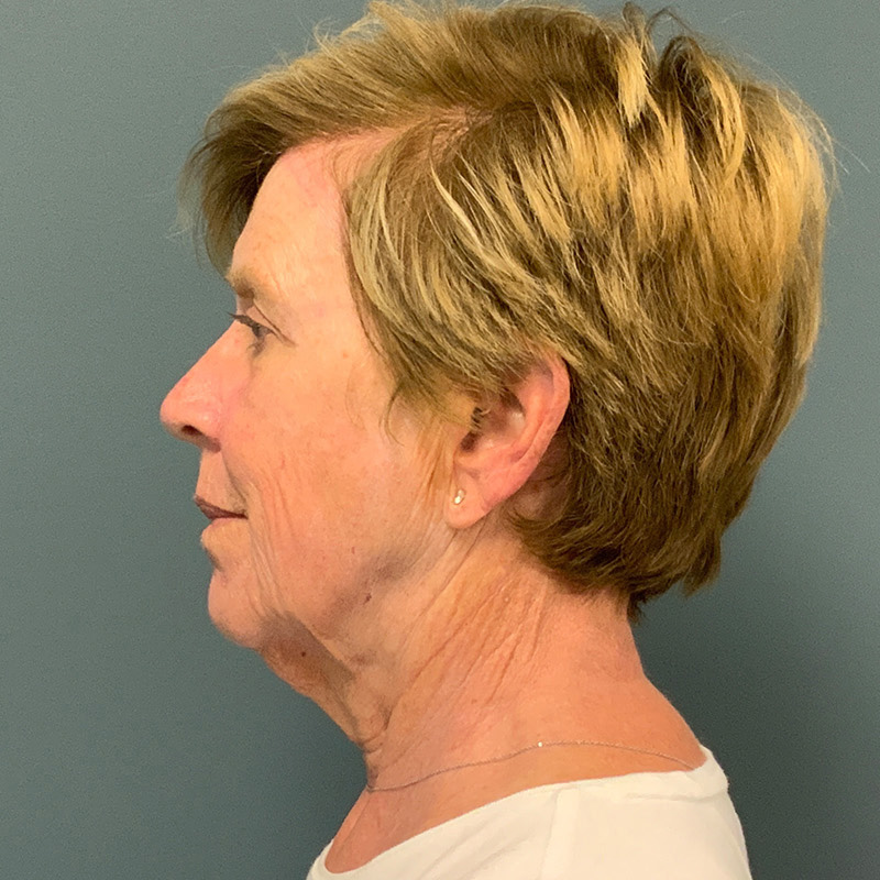before facelift left side view female patient case 5052