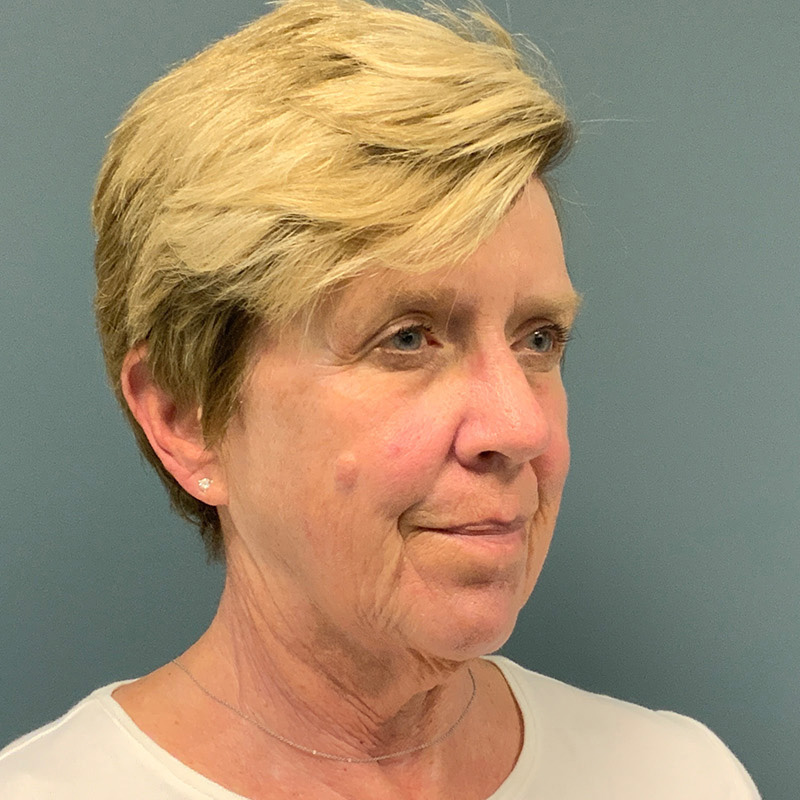 before facelift right view female patient case 5052