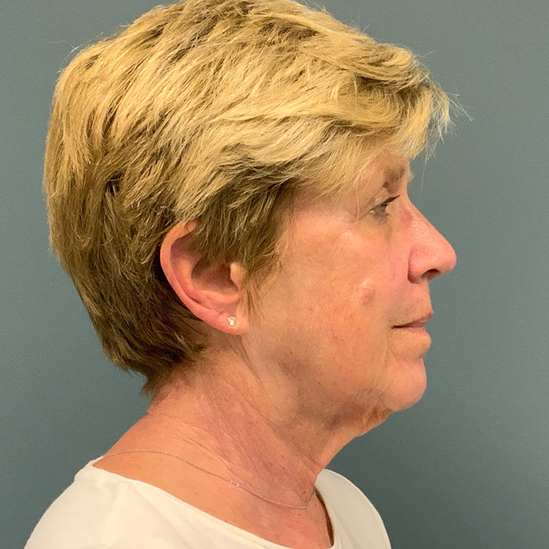 before facelift right side view female patient case 5052