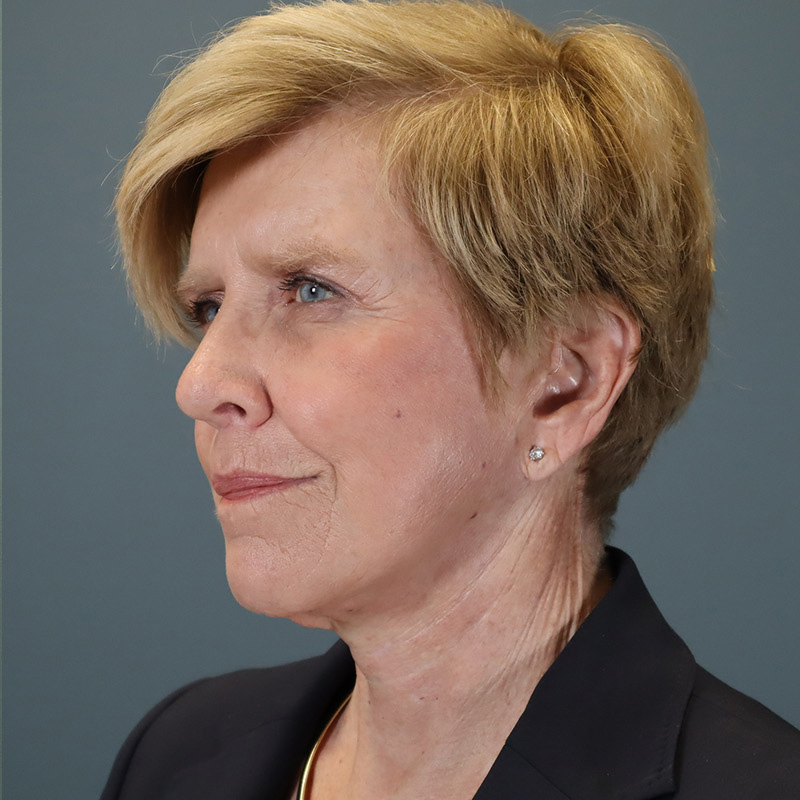 after facelift left view female patient case 5052