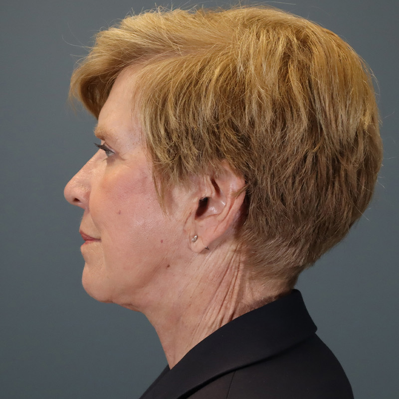 after facelift left side view female patient case 5052