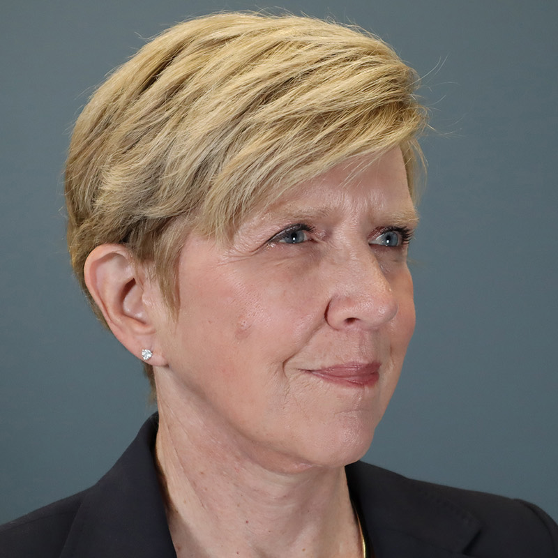 after facelift right view female patient case 5052