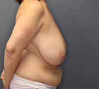 before mommy makeover right side view female patient case 5064