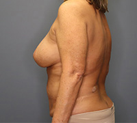 before mommy makeover left side view female patient case 5077