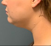 before liposuction left side view female patient case 5190