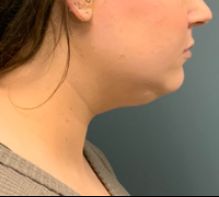 before liposuction right side view female patient case 5190