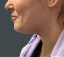 after liposuction left side view female patient case 5190