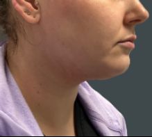 after liposuction right side view female patient case 5190