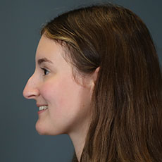 before rhinoplasty left side view female patient case 5195