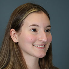 before rhinoplasty right angle view female patient case 5195