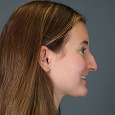 before rhinoplasty right side view female patient case 5195