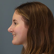 after rhinoplasty left side view female patient case 5195