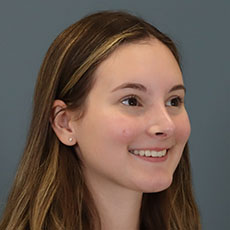 after rhinoplasty right angle view female patient case 5195