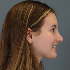 after rhinoplasty right side view female patient case 5195
