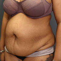 before tummy tuck left angle view female patient case 5220