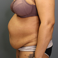 before tummy tuck left side view female patient case 5220