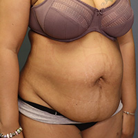 before tummy tuck right angle view female patient case 5220