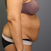 before tummy tuck right side view female patient case 5220