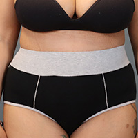 after tummy tuck front view female patient case 5220