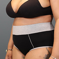 after tummy tuck left angle view female patient case 5220