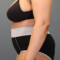 after tummy tuck left side view female patient case 5220