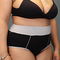 after tummy tuck right angle view female patient case 5220