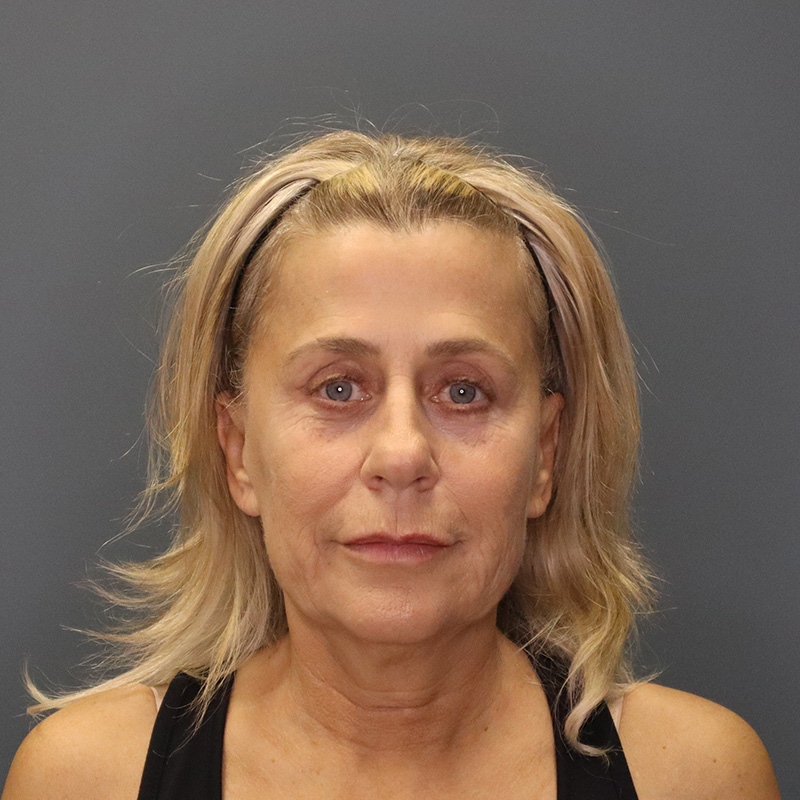 before neck lift front view female patient case 5234