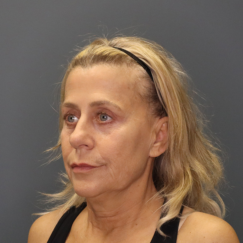 before neck lift left angle view female patient case 5234