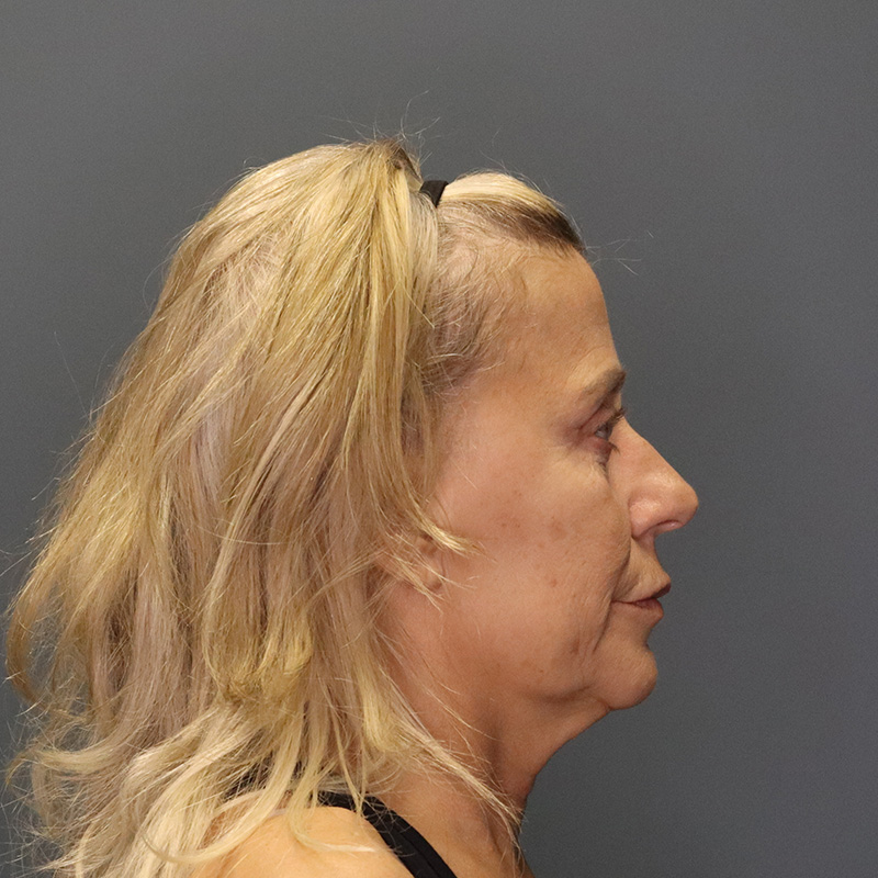 before neck lift right side view female patient case 5234