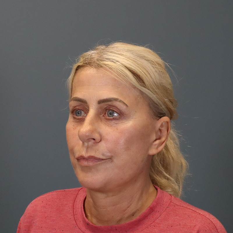 after neck lift left angle view female patient case 5234