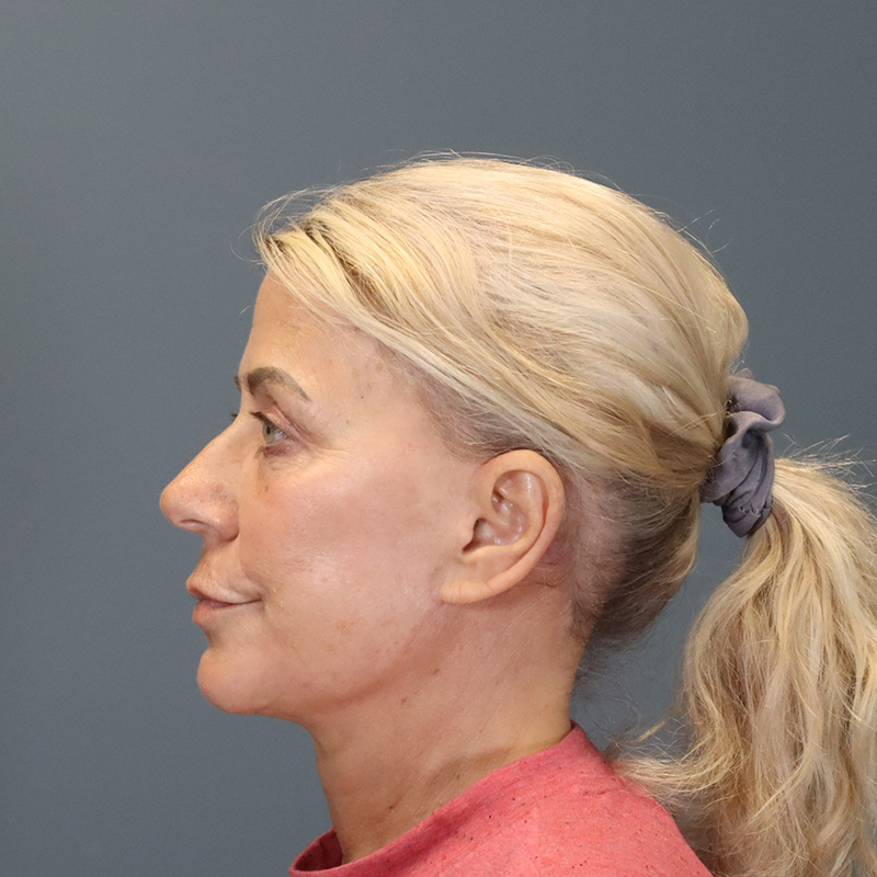 after neck lift left side view female patient case 5234