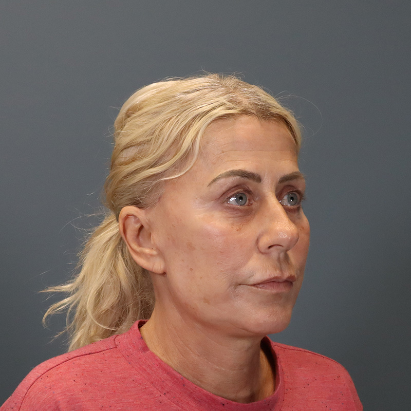 after neck lift right angle view female patient case 5234