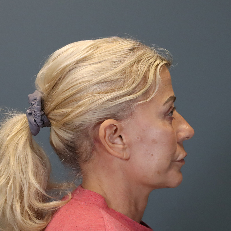 after neck lift right side view female patient case 5234