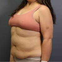 before tummy tuck left angle view female patient case 5356