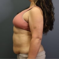 before tummy tuck left side view female patient case 5356