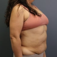 before tummy tuck right angle view female patient case 5356