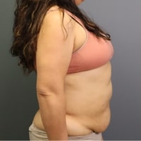 before tummy tuck right side view female patient case 5356