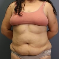 before tummy tuck front view female patient case 5356