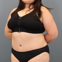 after tummy tuck left angle view female patient case 5356