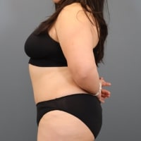 after tummy tuck left side view female patient case 5356