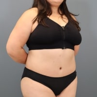 after tummy tuck right angle view female patient case 5356