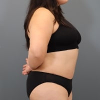 after tummy tuck right side view female patient case 5356