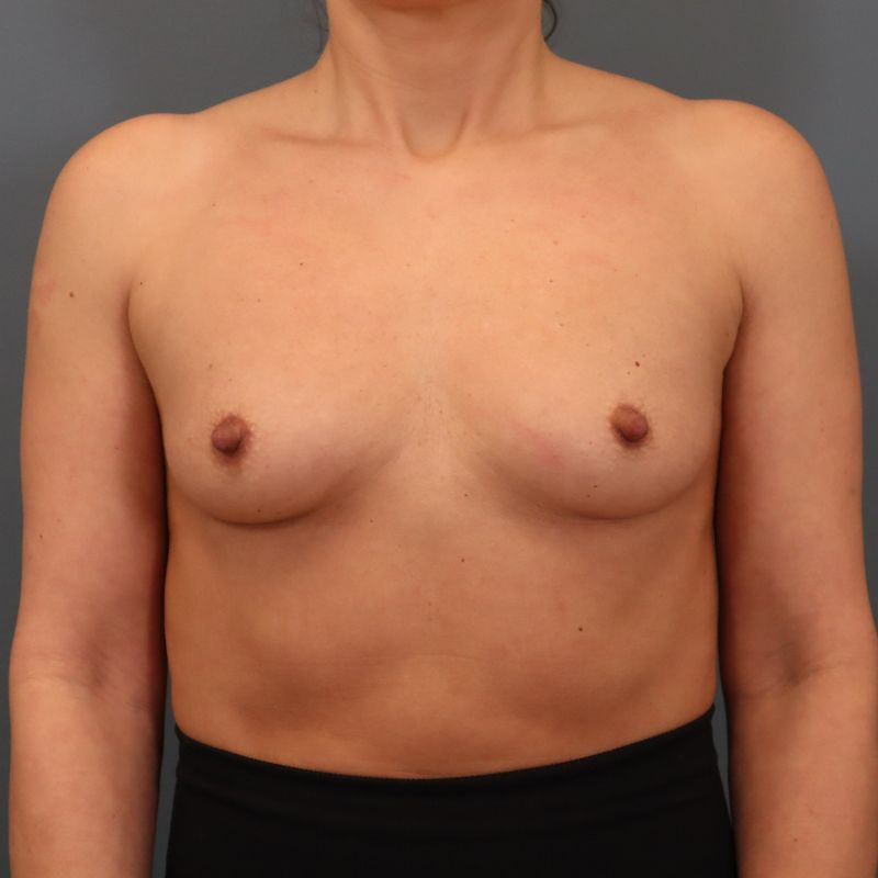 before breast augmentation front view of female patient 5741