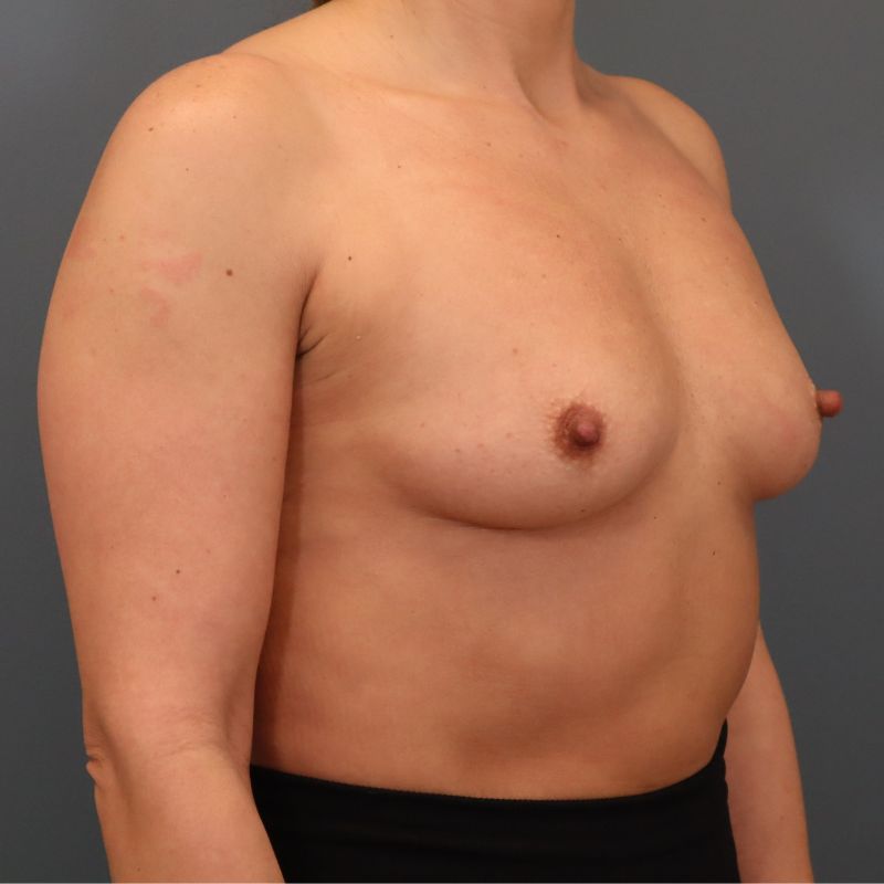 before breast augmentation right angle view of female patient 5741
